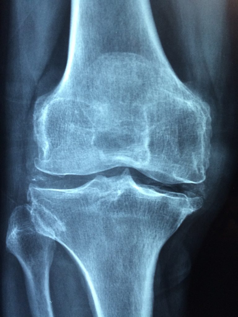 IMAGE: Arthritis