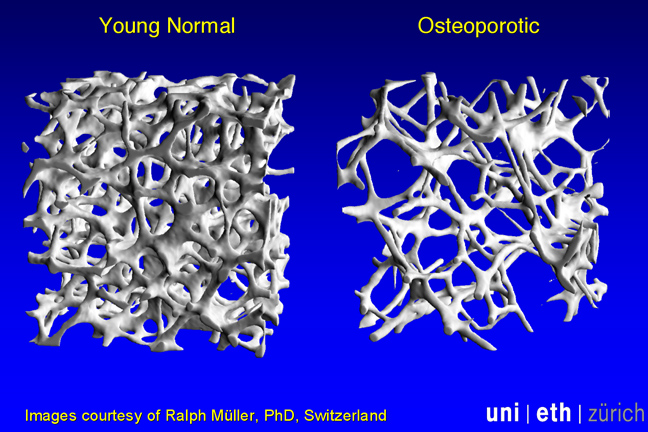 IMAGE - bones showing osteoporosis